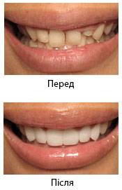 стоматологічні вініри